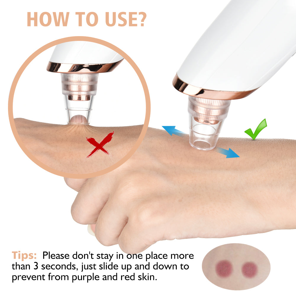 5 in 1 Blackhead Vacuum Cleaner – Instantly Remove Blackheads at Home
