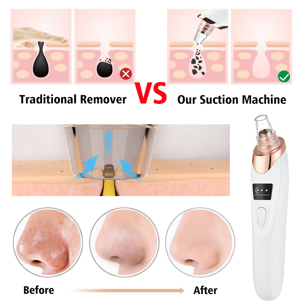 5 in 1 Blackhead Vacuum Cleaner – Instantly Remove Blackheads at Home